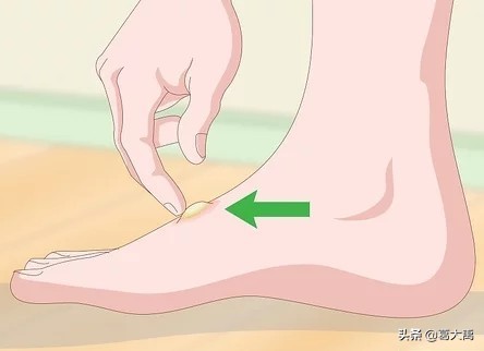 夏季如何辩认跳蚤的咬痕