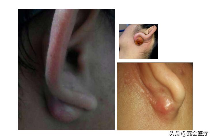 耳朵里面长了个肉疙瘩不疼严重吗,耳朵上长了个小疙瘩需要手术吗