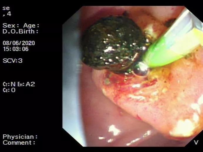 男子腹痛却找不出原因,男子腹痛难忍却查不出原因