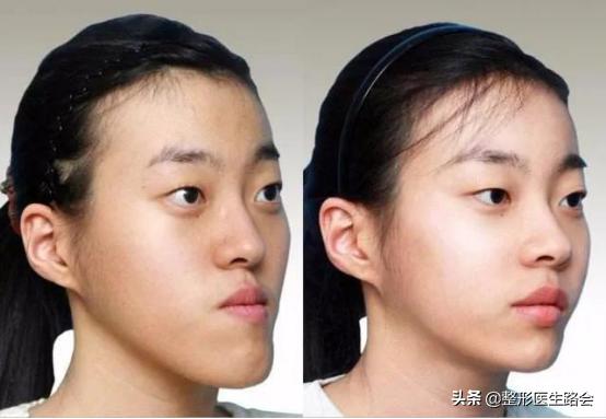 面中部凹陷下巴微翘,朱元璋式下巴怎么矫正