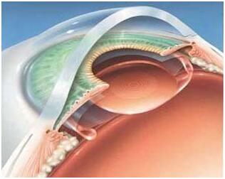 核性白内障与普通白内障手术区别,飞秒白内障与普通白内障手术
