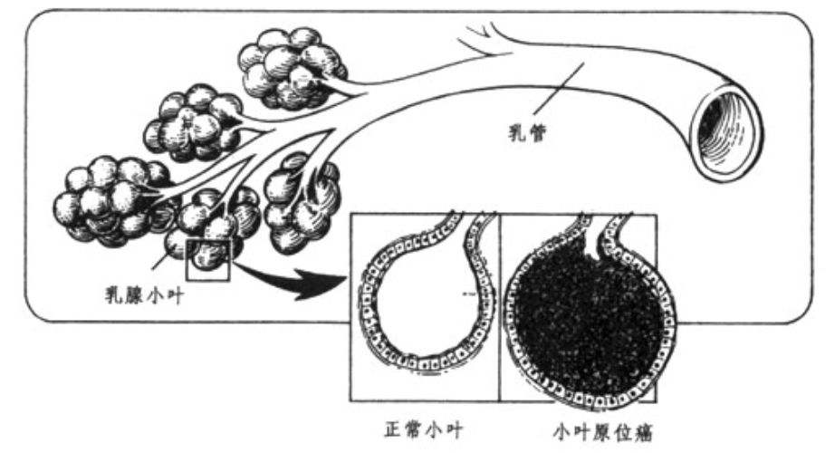 乳腺癌1期就是原位癌吗,乳腺癌小叶癌恶性程度