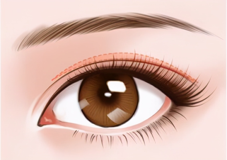 割双眼皮后变单眼皮,微创双眼皮恢复变三眼皮