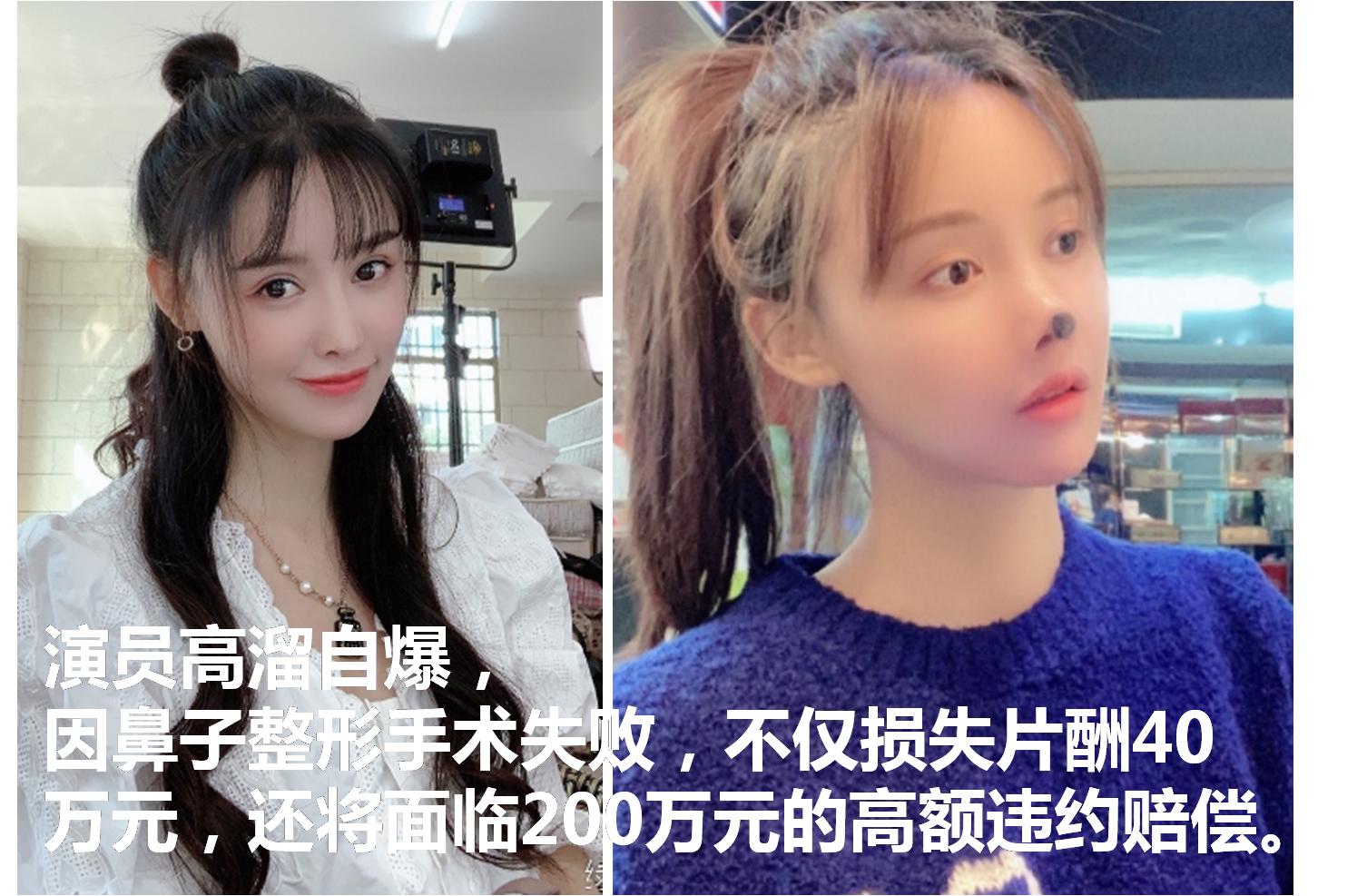 演员高溜整形鼻头坏死。整形换“美”到底值不值?