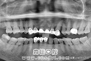 成人戴烤瓷冠能牙齿矫正吗,烤瓷冠牙齿矫正