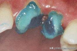 纤维桩修复费用,纤维桩修复全过程视频