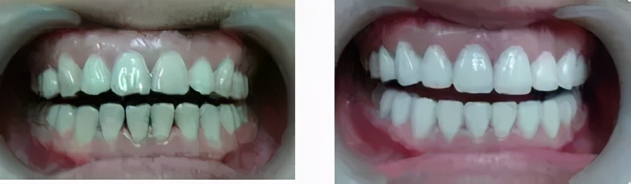 三甲医院全瓷牙保质期,全瓷牙有缝隙保质期是多久