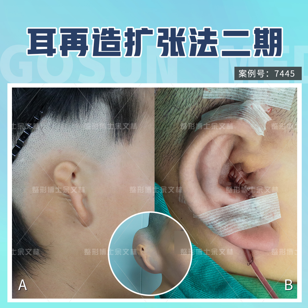 小耳畸形手术失败了还能修复吗,小耳畸形1度有必要手术再造吗