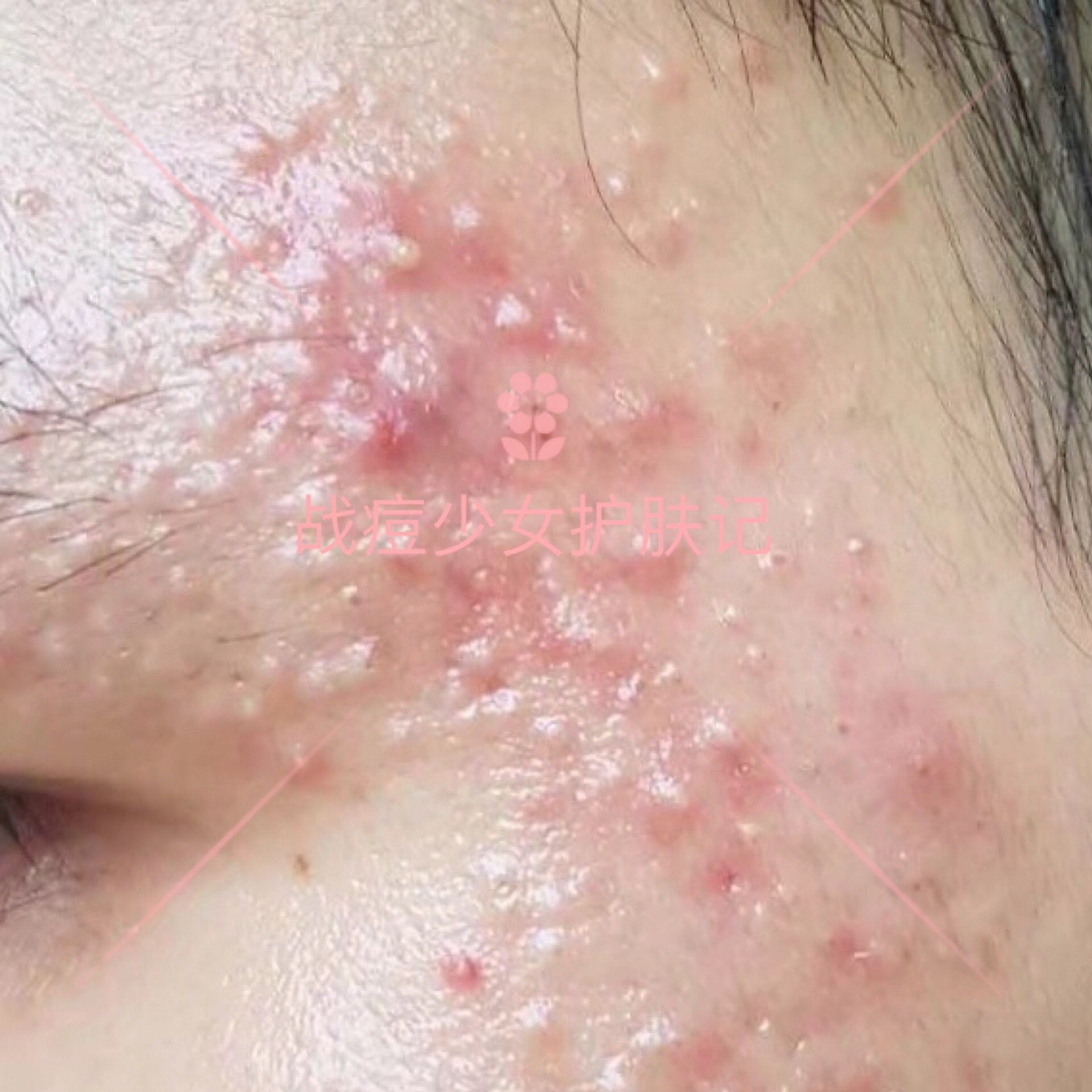 四种痘痘最佳治疗方法,各种痘痘的对症用药