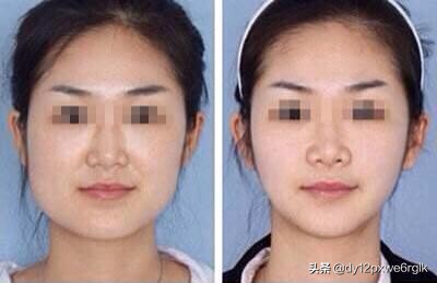 改善大小脸的按摩手法,怎样改善脸不对称大小眼