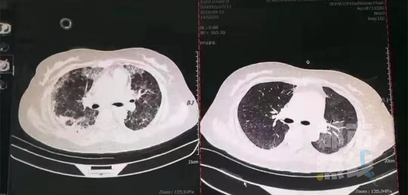 女子感染卡肺生命垂危医生借助“人工肺”生死营救