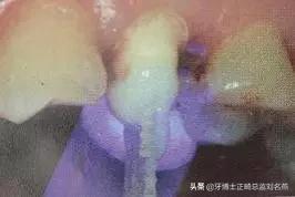 纤维桩修复费用,纤维桩修复全过程视频