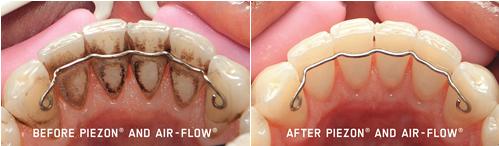 德州口腔医院洗牙团购,德州牙科整牙