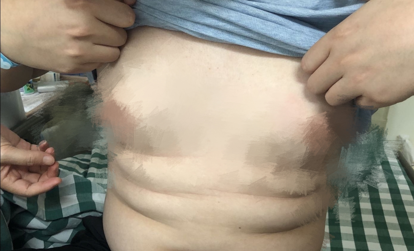 25岁小伙拥有B*杯罩**，胸部还会分泌乳汁学医女朋友的一句话，化解了他的难言之隐