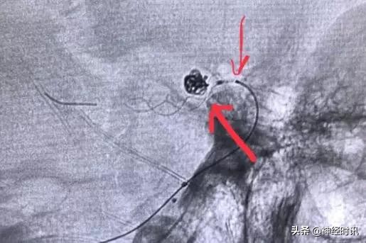 脑血管病介入治疗的介绍,缺血性脑血管病介入治疗进展2015