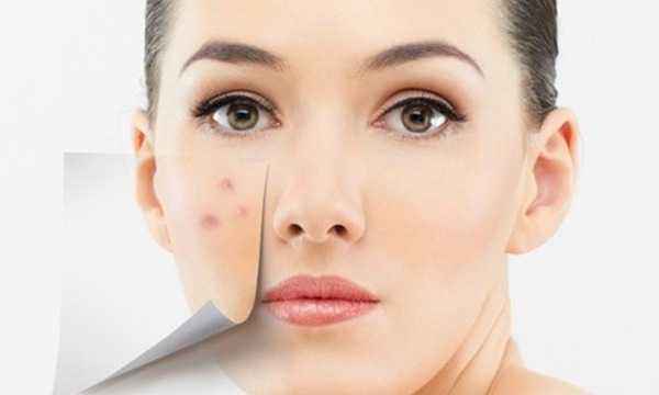 痘坑闭口痘印怎么祛除,怎么祛深层痘印和痘坑呢