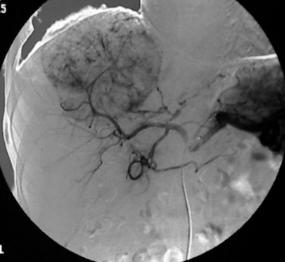 各种肿瘤并发症介入治疗,肿瘤和癌症早期怎么预防