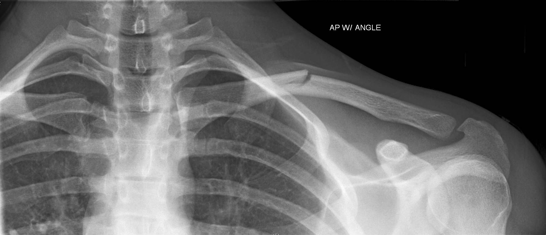 什么是新生儿锁骨骨折？该怎样护理！