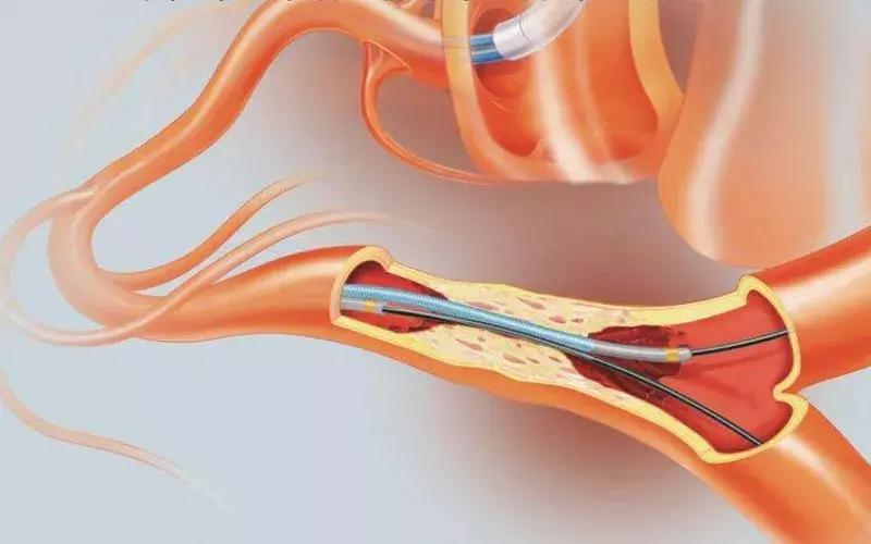 肿瘤介入治疗费用多少,走进肿瘤微创介入手术