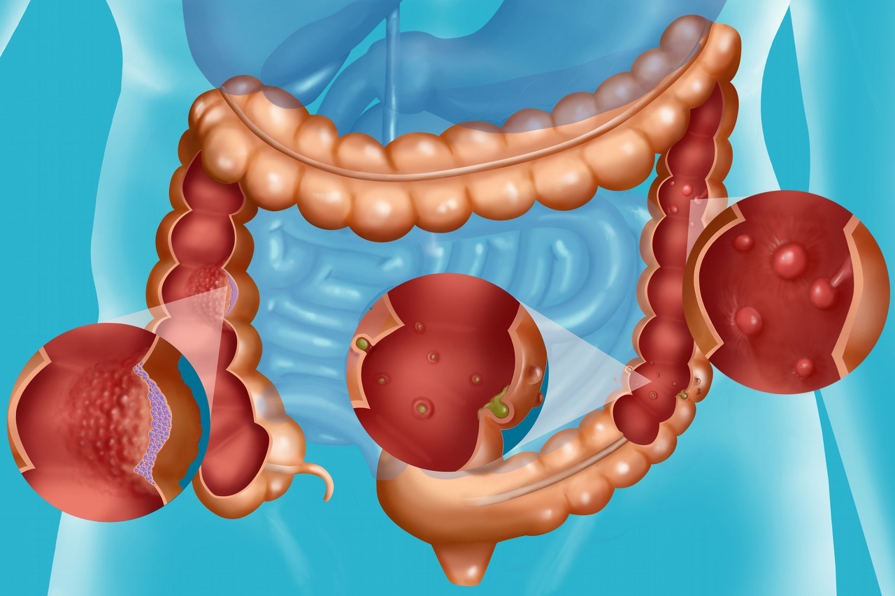 便秘除了开塞露还有什么特效药,便秘常用开塞露的危害有哪些