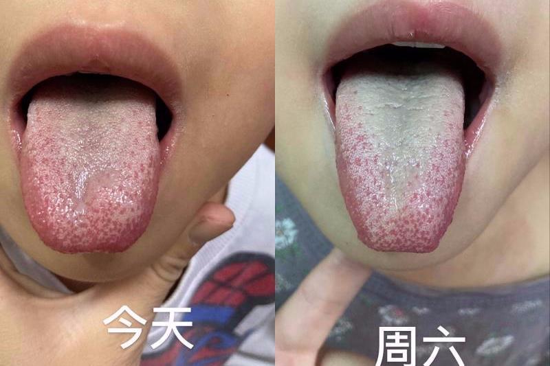 小孩肠道湿热大便粘腻怎么治疗,湿热体质人群日常饮食要注意什么