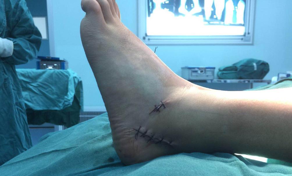 中年人扁平足做微创手术,僵硬型扁平足手术