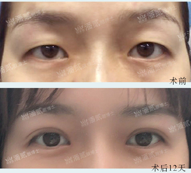 开内眼角失败留疤了怎么办,开外眼角恢复期间会有紧绷感么