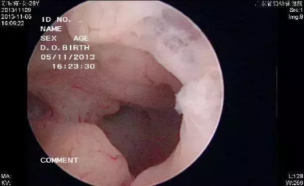 多囊跟多囊卵巢综合征有什么区别,双侧卵巢多囊样改变和多囊综合征