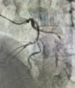 oct在冠脉介入的应用,广西冠脉介入治疗
