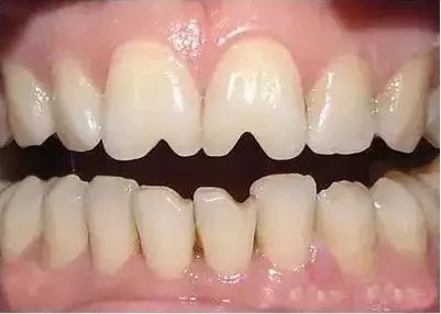 乳牙磕瓜子恒牙为什么变瓜子牙了,爱嗑瓜子