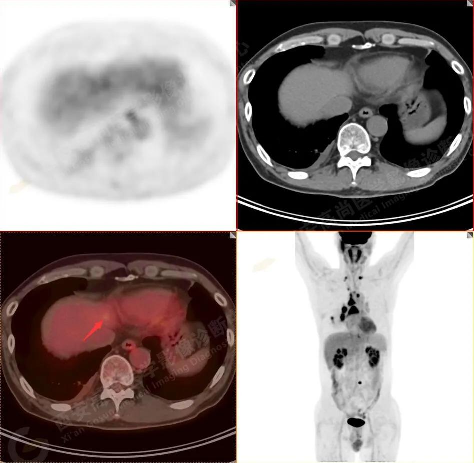 petct检查报告肺结节考虑恶性肿瘤,30mm肺结节pet显示没有转移
