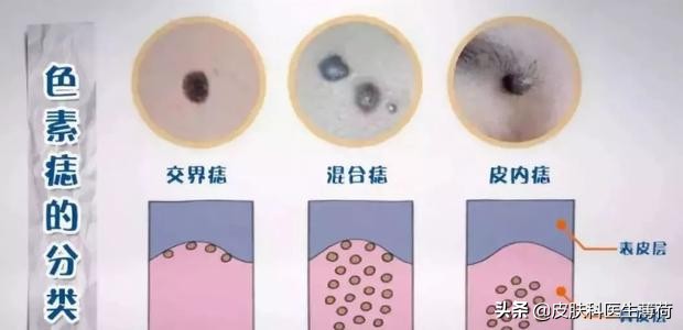 脸上有斑是做冷冻还是激光,黄褐斑用激光祛好还是吃中药