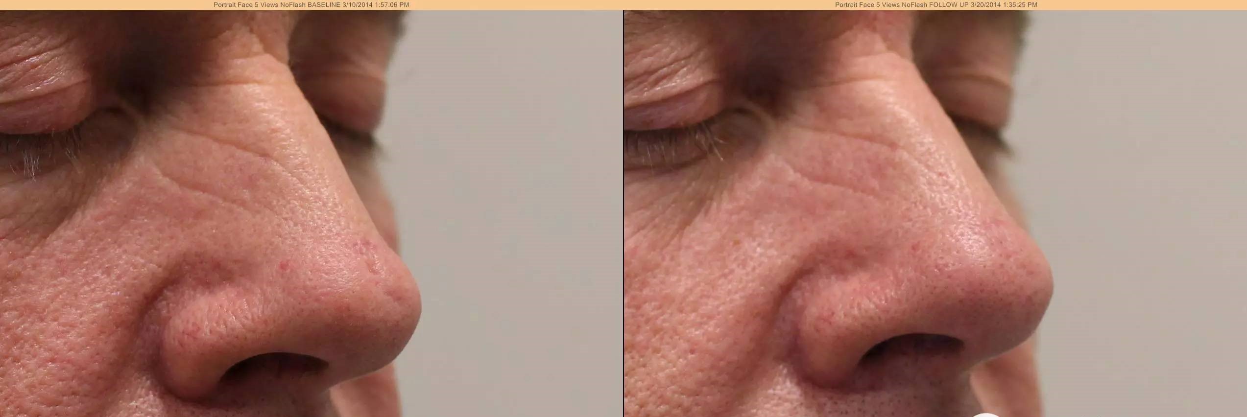 痘坑可以通过护肤手段平复吗,痘坑如何正规治疗