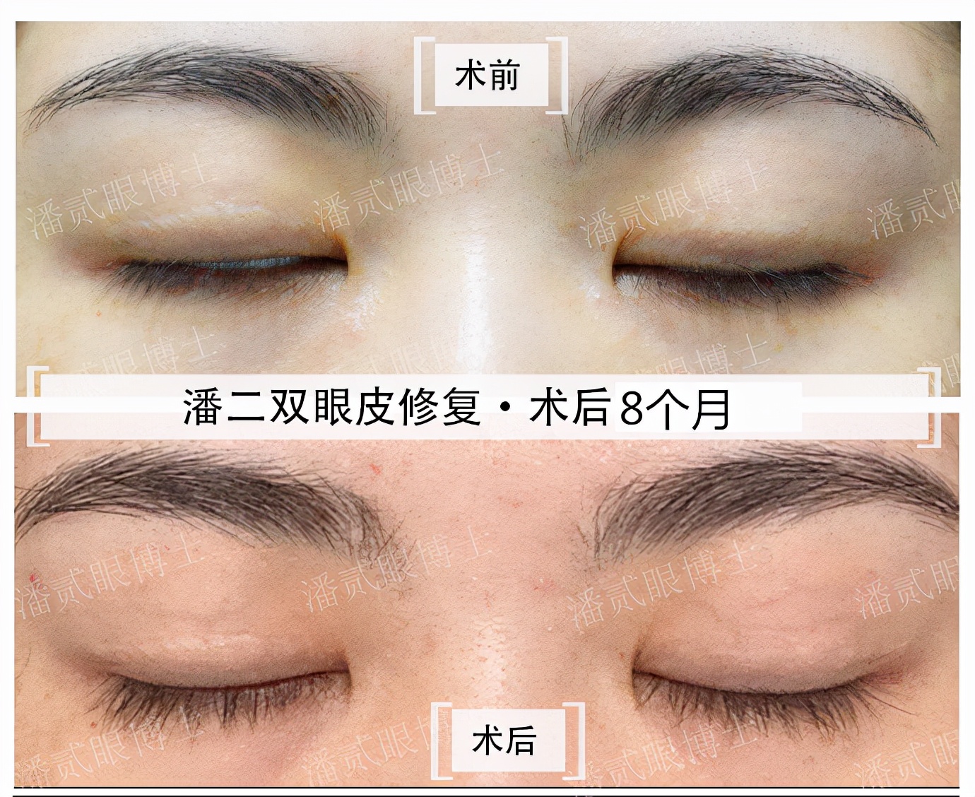 双眼皮修复案例真实,双眼皮修复会越来越糟吗