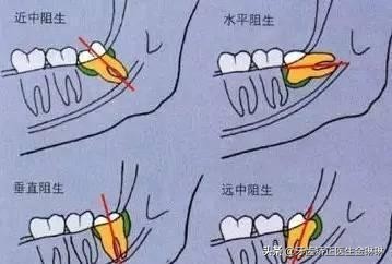 下面有两颗智齿到底要不要拔掉,没有长出来的智齿到底要不要拔掉