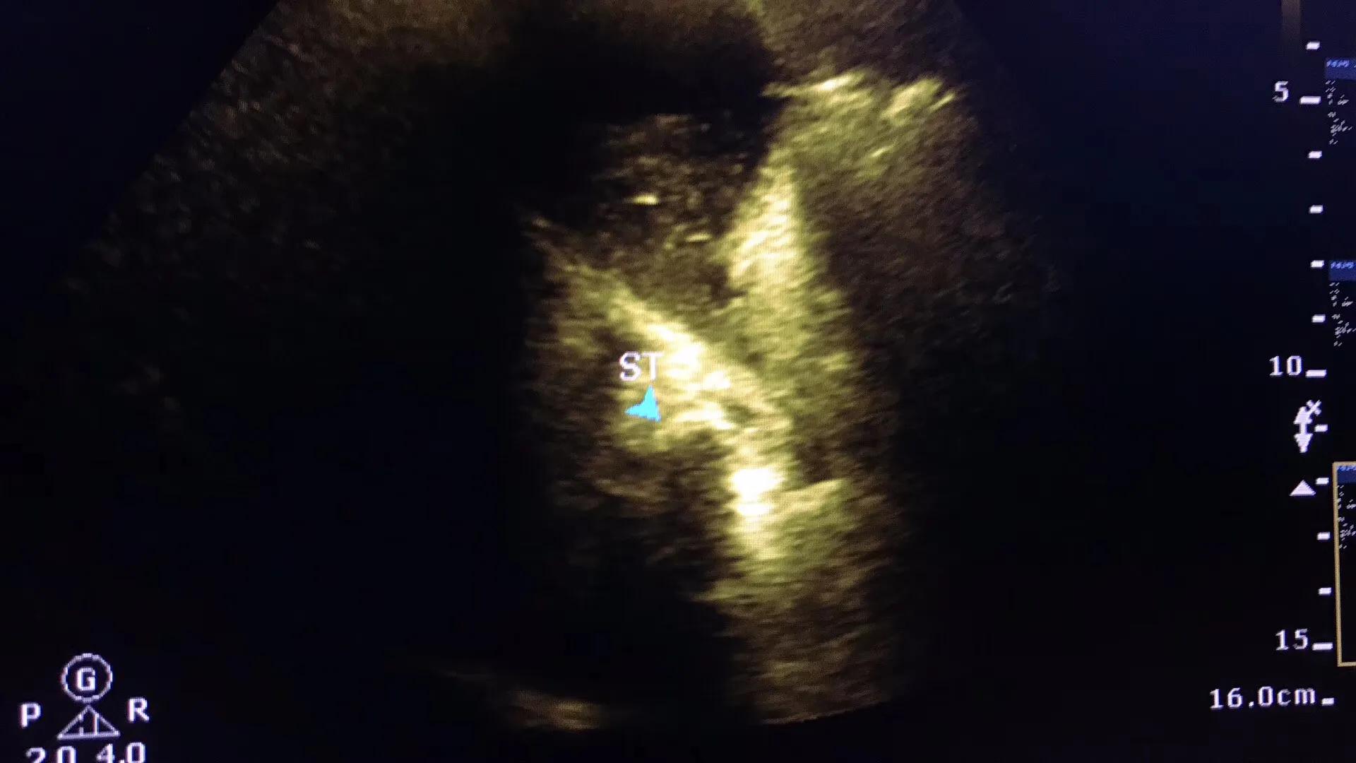 一公分胆结石并且引发急性胆囊炎,一颗胆结石必须摘胆吗