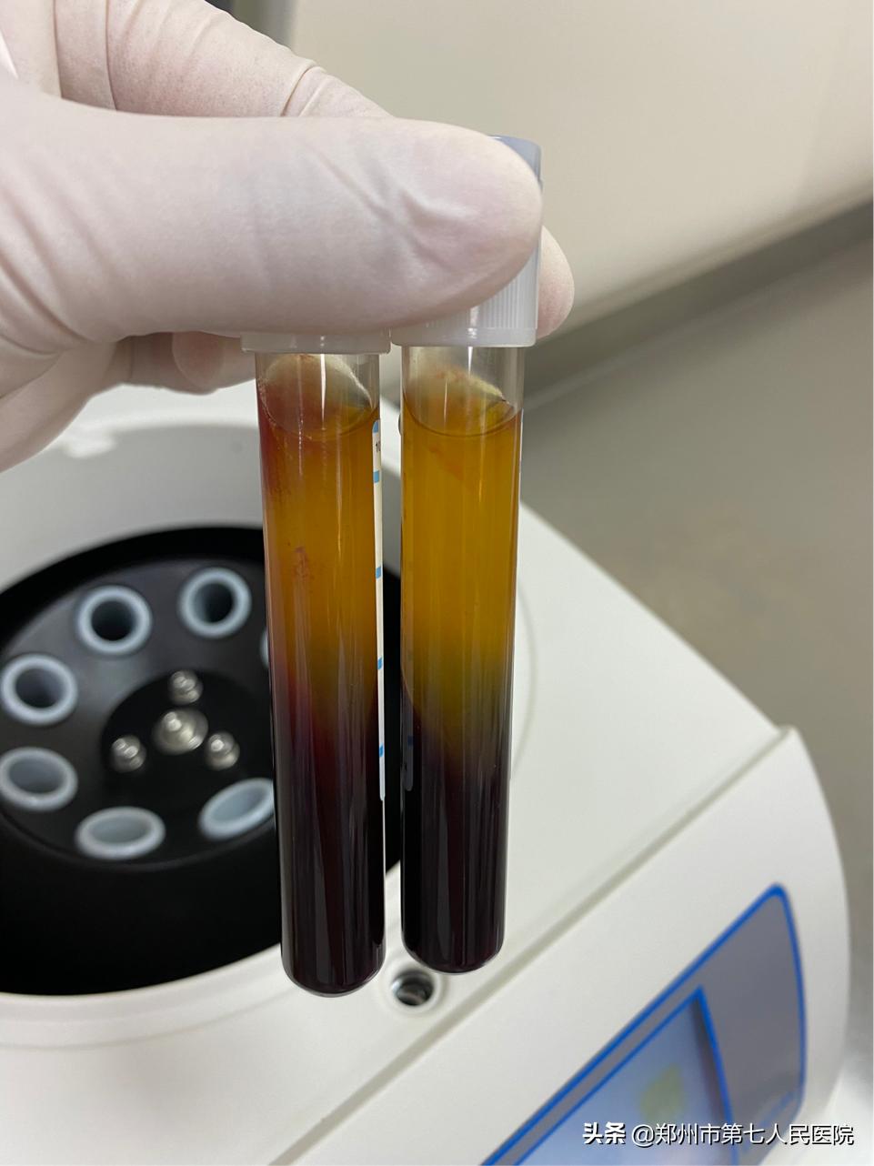 看牙也抽血？什么是CGF？