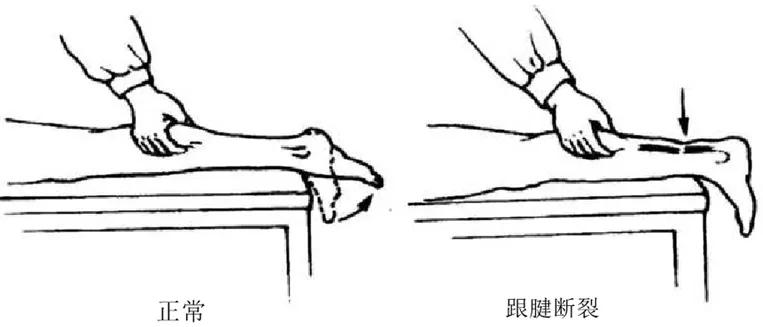 跟腱断裂术后康复训练,跟腱断裂恢复的小偏方