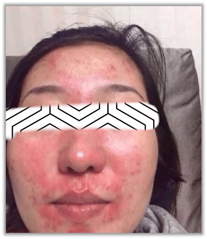 红血丝容易过敏怎么修复,过敏引起红血丝图片