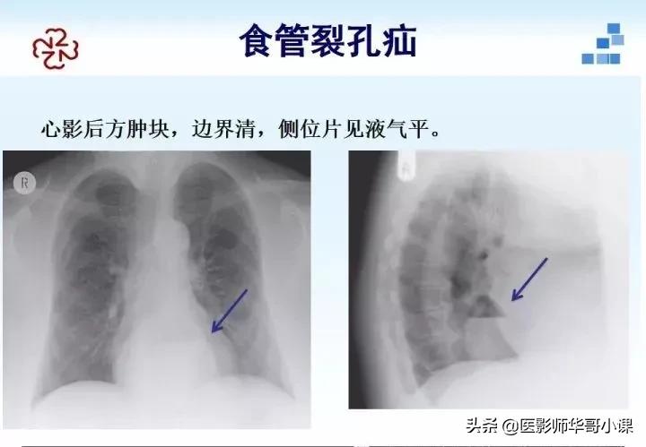 「精品课件」胸部膈肌的解剖及常见病变影像的表现