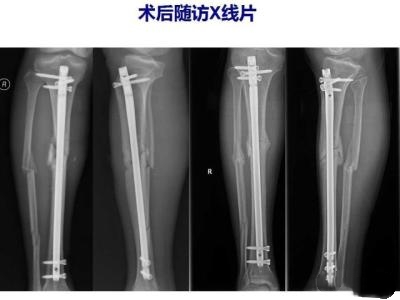 骨折后,人体会经历怎样的变化?