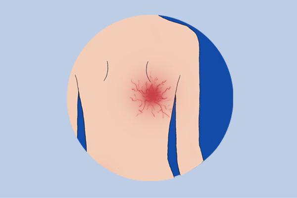 身上起红痣很痒怎么回事,身上突然起红痣很痒怎么回事