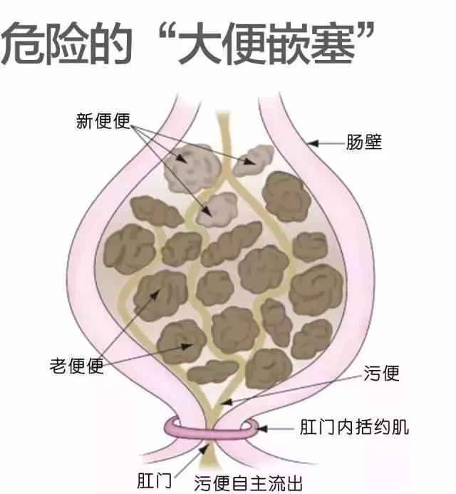 粪嵌塞是什么意思,粪嵌塞的症状