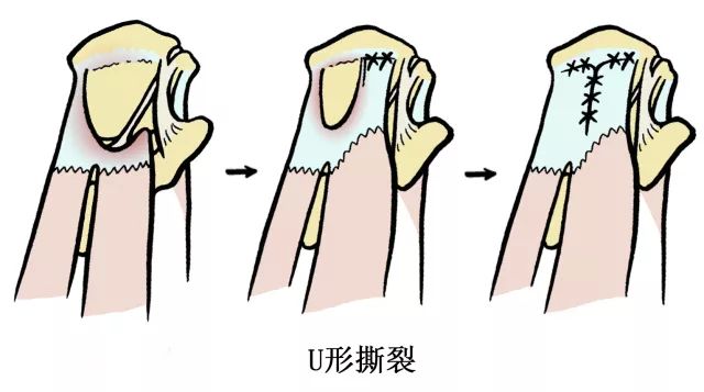 肩伤如何练肩,骨科专家教你肩袖康复训练