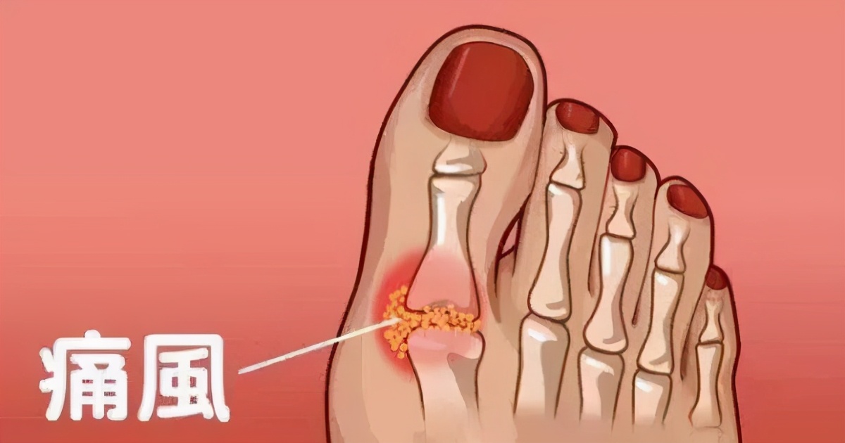 治痛风降尿酸的药分别有哪些,降尿酸治痛风吃什么药最安全有效