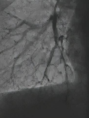 一个肠息肉切除干净后还会复发吗,肠息肉esd手术可以切除多大息肉