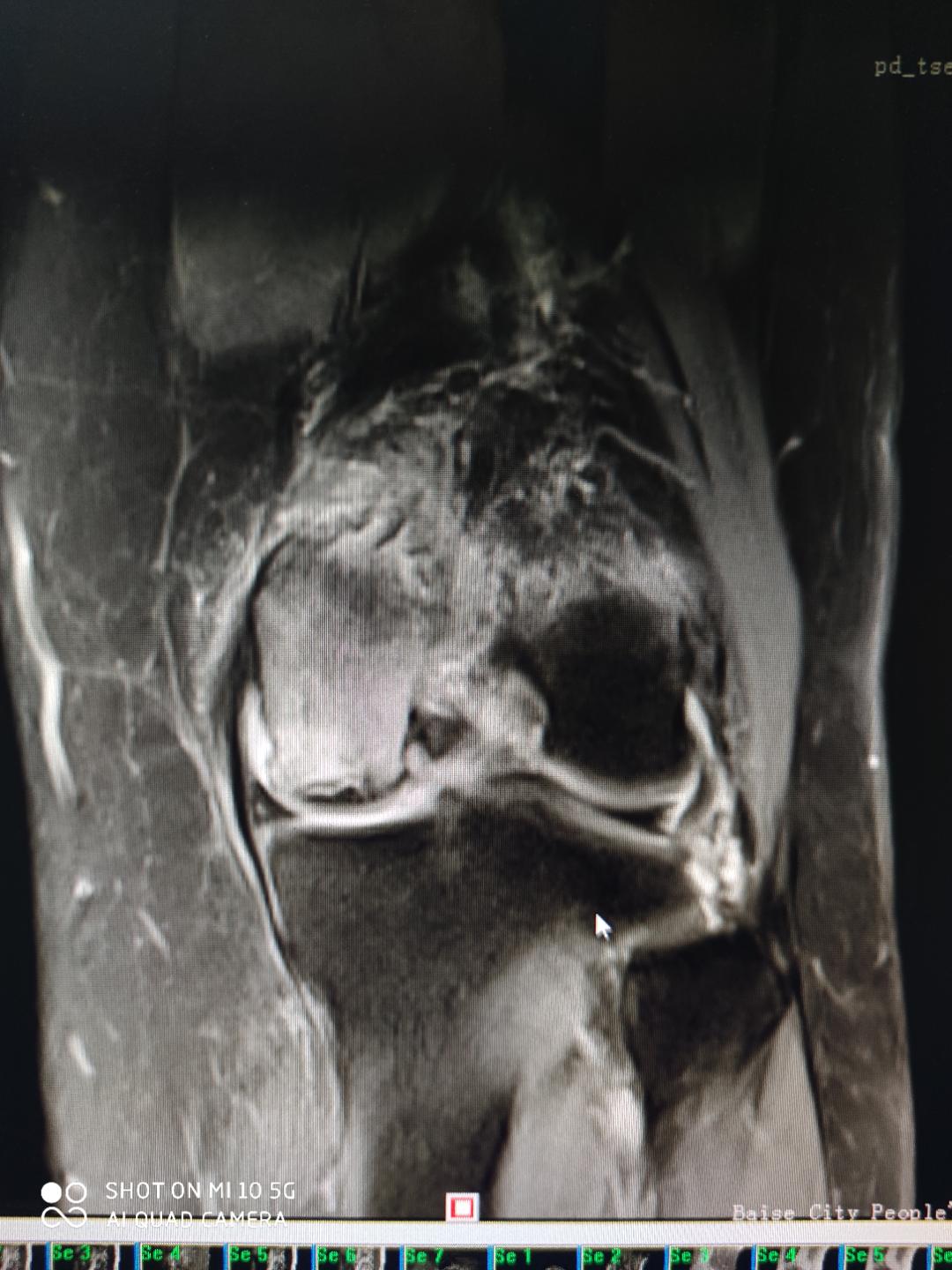 百色市人民医院关节外科开展膝关节单髁置换术,保膝技术再添“法宝”