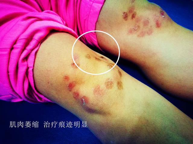 面对多种治疗半月板损伤的办法，我们应该做加法还是做减法？