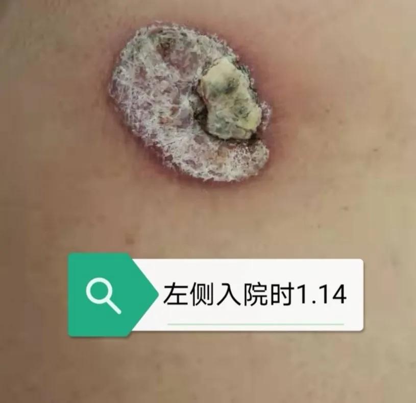 压疮的治疗成功和护理案例,压疮怎么护理好得快