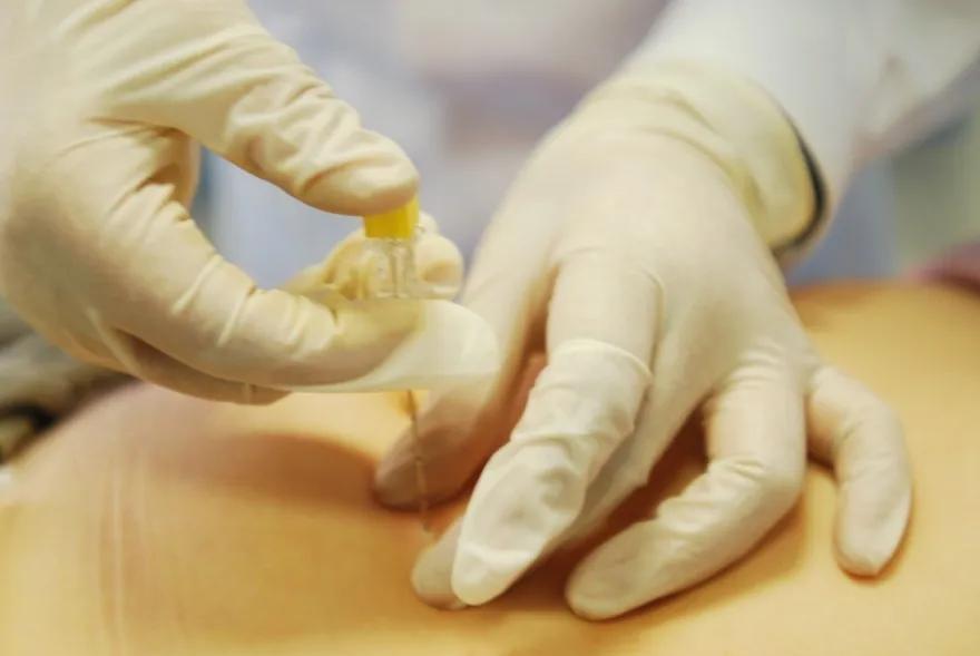 中医埋针减肥可以减肥多少斤,安康市中医医院埋线减肥